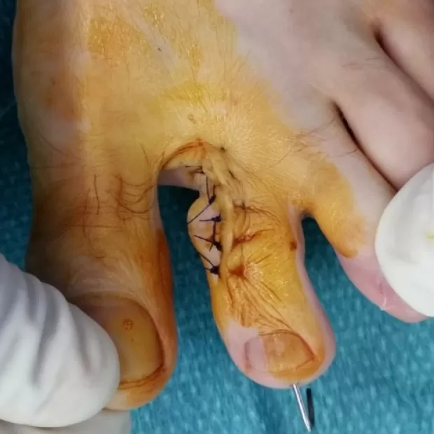 Agarrotamiento de los dedos de los pies causas